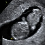 USG wczesna ciąża